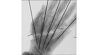 Röntgenbild der Hand nach der Replantation. Von der Handwurzel aus reichen fünf lange Drähte in jeden Finger.