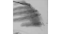 Röntgenbild des abgetrennten Teils einer Hand. Die Schnittkante verläuft diagonal von links unten nach rechts oben.