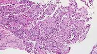 Histologisches Bild bei PostCovid