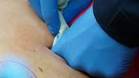 Tamponieren einer penetrierenden Verletzung